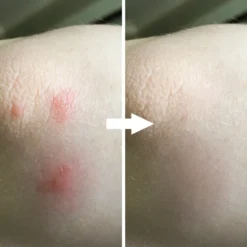 3 Mückenstich-Klicker 13 3 Mückenstich-Klicker -Günstiges Laube Lust Geschäft cec2661789f9d8f9d5ea3043f337087a