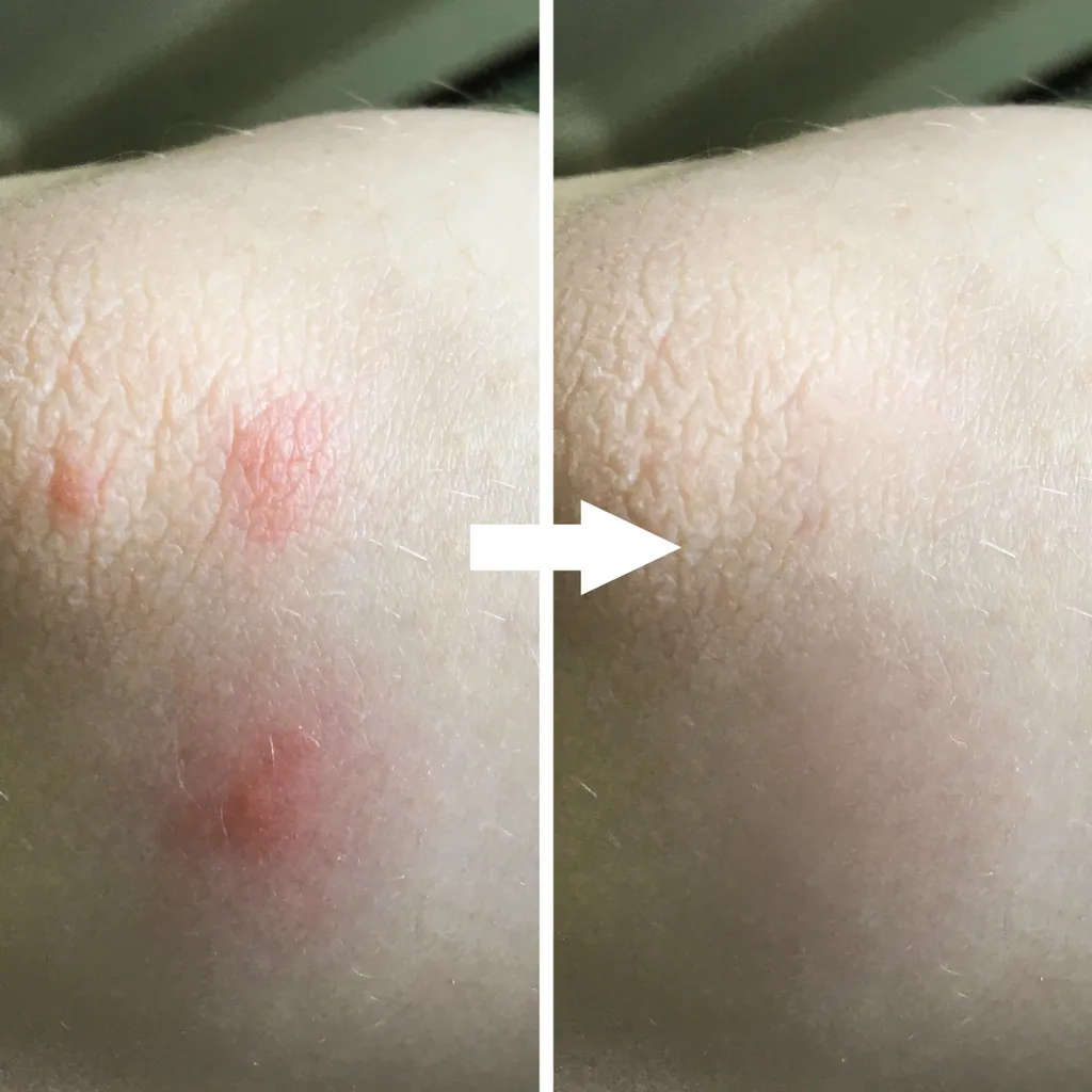 3 Mückenstich-Klicker 5 3 Mückenstich-Klicker – Bild 3